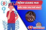 cac-bieu-hien-benh-giang-mai-o-nam-gioi.jpg